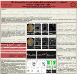 OCT Angiography Reveals Subretinal Neovascularization in a Case of Macular Telangiectasia Type 2